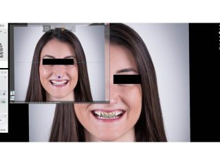 Diseño Dígital de Sonrisa
