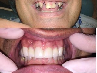 Rehabilitación Superior en Zirconio
